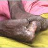 Symptoms of Leprosy The most common symptoms of leprosy are  Symptoms of Leprosy  1