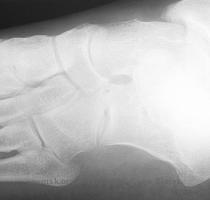 osseous coalition  It will also show joint space narrowing  irregularity and sclerosis in a cartilaginous or fibrous coalition  Complete osseous  Cartilaginous or fibrous coalition  Talo calcaneal  The Harris Beath view  a penetrated posterior oblique image  aka  the penetrated axial view   with the patient standing on the cassette and the beam angled between 35 and 45