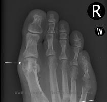 Shows classic location at first MTP and small erosion with  overhanging  edge  Notice that the joint space and bone density are preserved  Another appearance showing multiple erosion locations including first MTP  base of third and fourth metacarpals  and possibly the head of the fifth metacarpal and second proximal phalanx