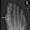 Shows classic location at first MTP and small erosion with  overhanging  edge  Notice that the joint space and bone density are preserved  Another appearance showing multiple erosion locations including first MTP  base of third and fourth metacarpals  and possibly the head of the fifth metacarpal and second proximal phalanx