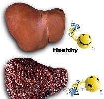 Cirrhosis ??? ???? ?????? ?????? ?? ????? ?????? ??????  ???? ??? ??? ?????? ????? ??????  ????? ???? ?????