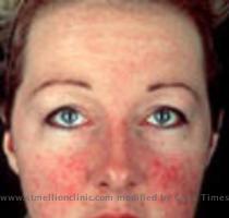 Seborrheic Dermatitis Treatments Many treatment modalities have been attempted to eradicate these lesions   including