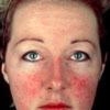 Seborrheic Dermatitis Treatments Many treatment modalities have been attempted to eradicate these lesions   including