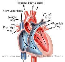 Patent Foramen Ovale  PFO  One of the most significant predisposing risk factors in DCS is a physical abnormality of the heart called Patent Foramen Ovale  PFO    a small opening between the upper two chambers of the