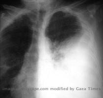 Empyema caused by Streptococcus pneumoniae  Anteroposterior film