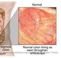 Ulcerative colitis Ulcerative colitis causes inflammation and sores  ulcers  in the lining of the large intestine  Ulcers form where the inflammation has killed the cells lining the colon  the ulcers bleed