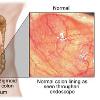 Ulcerative colitis Ulcerative colitis causes inflammation and sores  ulcers  in the lining of the large intestine  Ulcers form where the inflammation has killed the cells lining the colon  the ulcers bleed