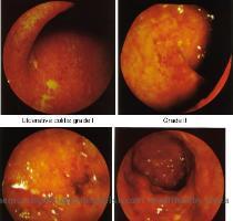 Crohn s Disease In Crohn s Disease  previously known as regional ileitis