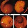 Crohn s Disease In Crohn s Disease  previously known as regional ileitis