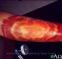 Lyme disease  erythema chronicum migrans  Erythema chronicum migrans is the initial lesion of Lyme disease  and often appears at the site of the infecting tick bite  It is a red  enlarging rash  flat or slightly raised  and may reach