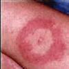 shingles appear as a blistering skin rash that can last for several weeks  It s very uncomfortable  and some people     Lyme Disease   don t panic  just get informed   Examiner com Examiner com   May 13  2008Lyme Disease is usually treatable when caught early  so your next step is to watch for a rash and other Lyme symptoms  The rash is called erythema migrans