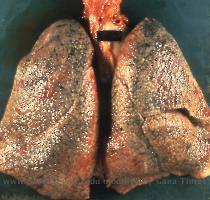 by dense scars  Retraction of the scar  especially of lobular septa  gives the external surface of the lung a hob nailed appearance  hence the term  pseudocirrhosis   1  Gross Image of Diffuse Interstital Fibrosis  click 2  Gross image Idiopathic Pulmonary Fibrosis  click On histologic examination  the  cyst   in reality