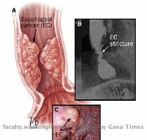 3  Identify the possible significance of a complaint of progressive dysphagia  E res Zen Seeker