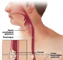 cell cancer arises from the cells that line the upper part of the esophagus  Adenocarcinoma arises from glandular cells that are present at the junction of the esophagus and stomach  Esophageal tumors usually lead to dysphagia  difficulty swallowing   pain and other symptoms  and are diagnosed with biopsy  Small and localized tumors are treated surgically with curative