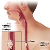 cell cancer arises from the cells that line the upper part of the esophagus  Adenocarcinoma arises from glandular cells that are present at the junction of the esophagus and stomach  Esophageal tumors usually lead to dysphagia  difficulty swallowing   pain and other symptoms  and are diagnosed with biopsy  Small and localized tumors are treated surgically with curative