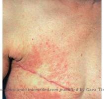 Cutaneous Metastases Figure 10  Click to Enlarge