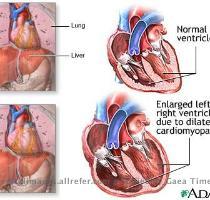 Alcoholic Cardiomyopathy