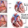 Pictures   Images Alcoholic Cardiomyopathy Excessive use of alcohol has a direct toxic effect on the heart muscle cells  The heart muscle becomes weakened and cannot pump blood efficiently  The lack of