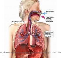 aspiration pneumonia1