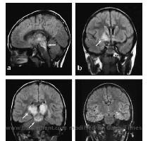 Encephalitis lethargica  part of a spectrum of post streptococcal autoimmune diseases