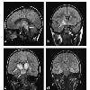 Encephalitis lethargica  part of a spectrum of post streptococcal autoimmune diseases