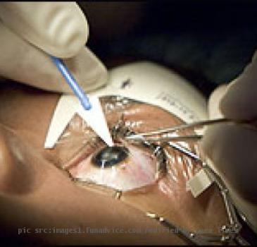 lasik eye surgery